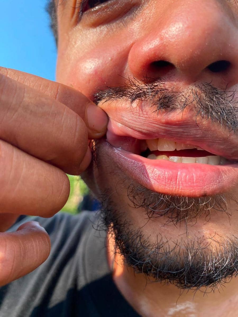 Seorang warga memperlihatkan luka pada bibir akibat represi dari aparat/Dok. LBH Makassar