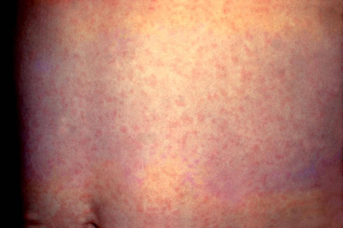 Campak atau Rubella? Perhatikan Urutan Munculnya Gejala