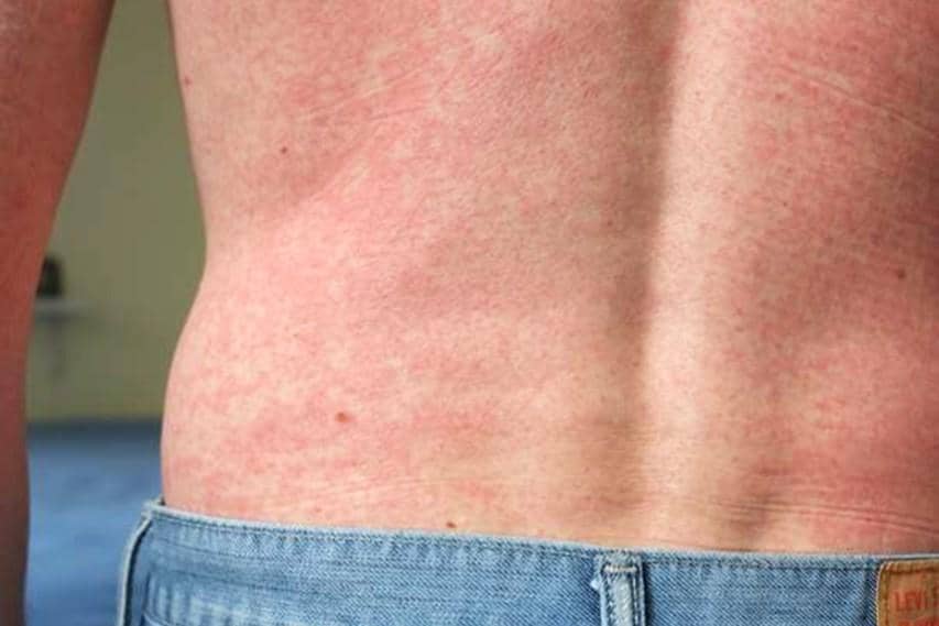 Daftar Gejala Infeksi Virus Zika yang Perlu Dikenali