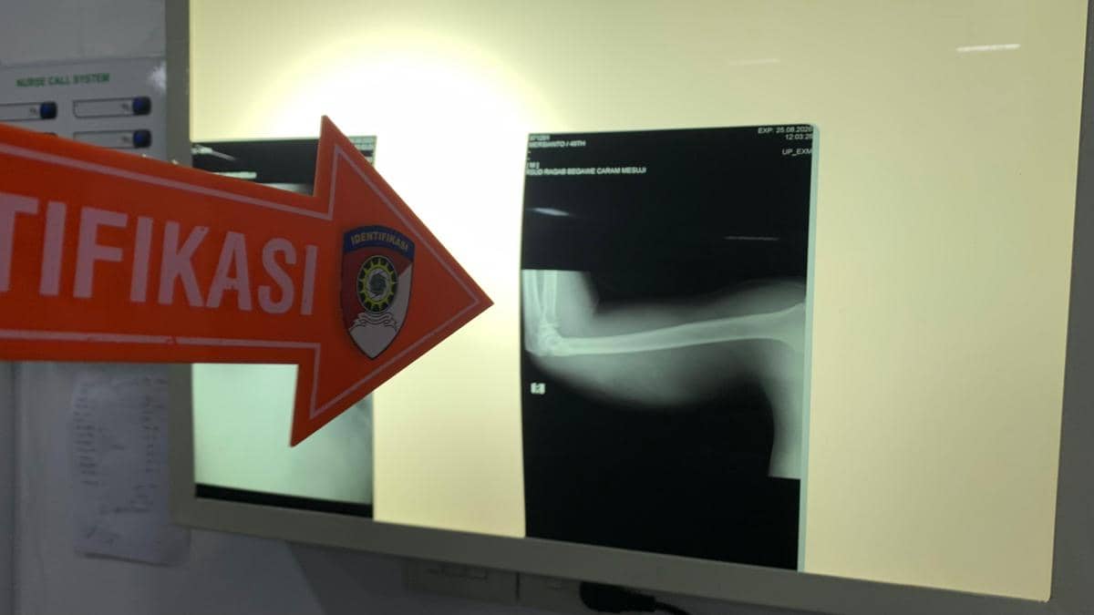 Perkara Utang Rp20 Juta, Pria di Mesuji Ditembak Rekan Sendiri