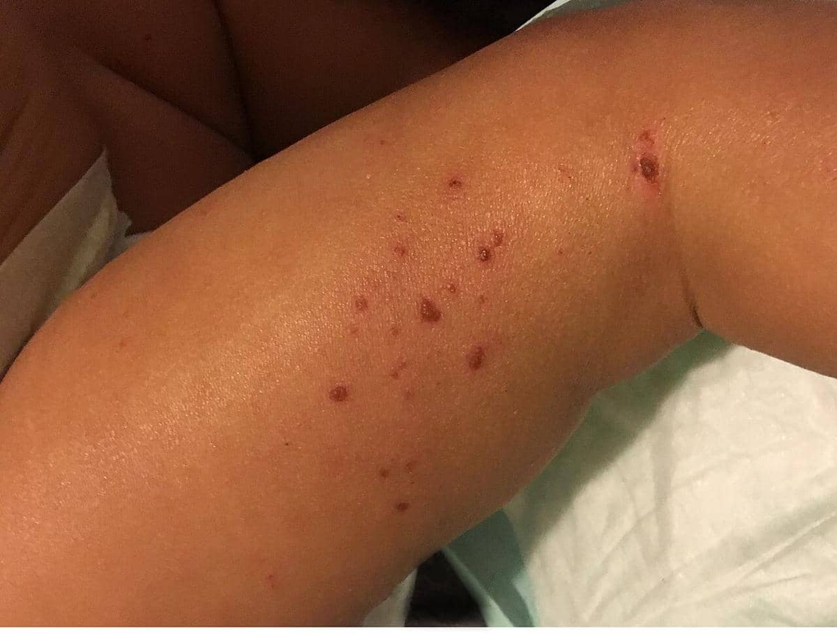 Ilustrasi anak dengan eksim atau dermatitis atopik, terlihat ruam kemerahan dan kulit kering pada tubuhnya.
