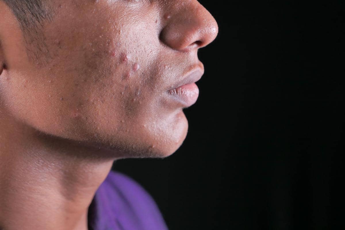 Ilustrasi close-up wajah pria berjerawat