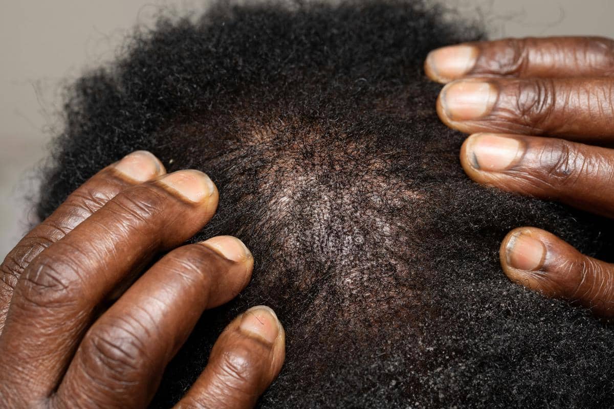 Kenapa Psoriasis Kulit Kepala Sering Disangka Sebagai Ketombe?