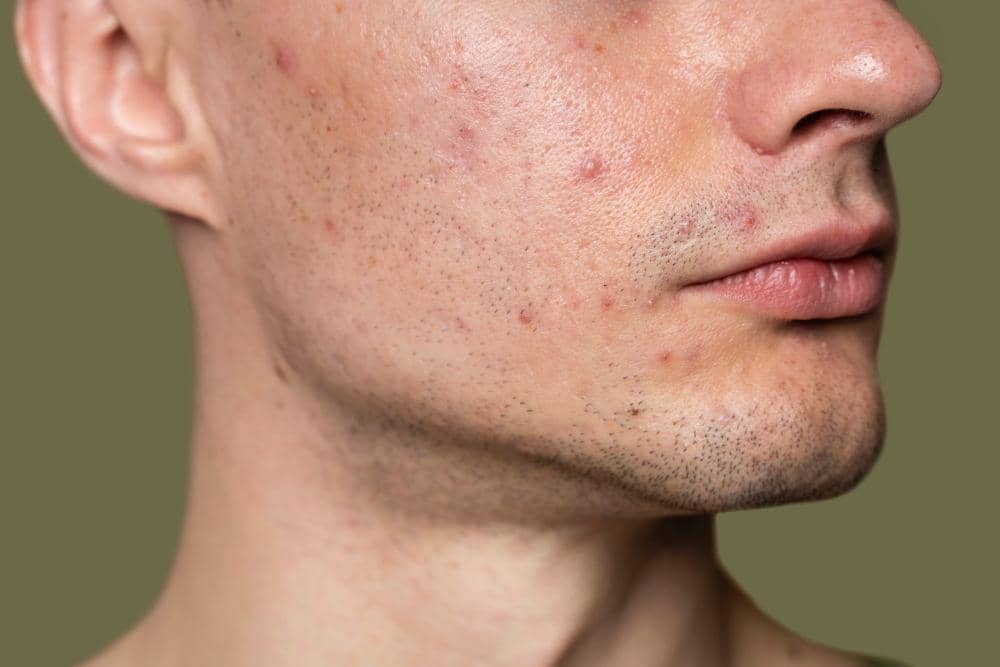 5 Rekomendasi Serum untuk Mengatasi Breakout yang Efeknya Menenangkan