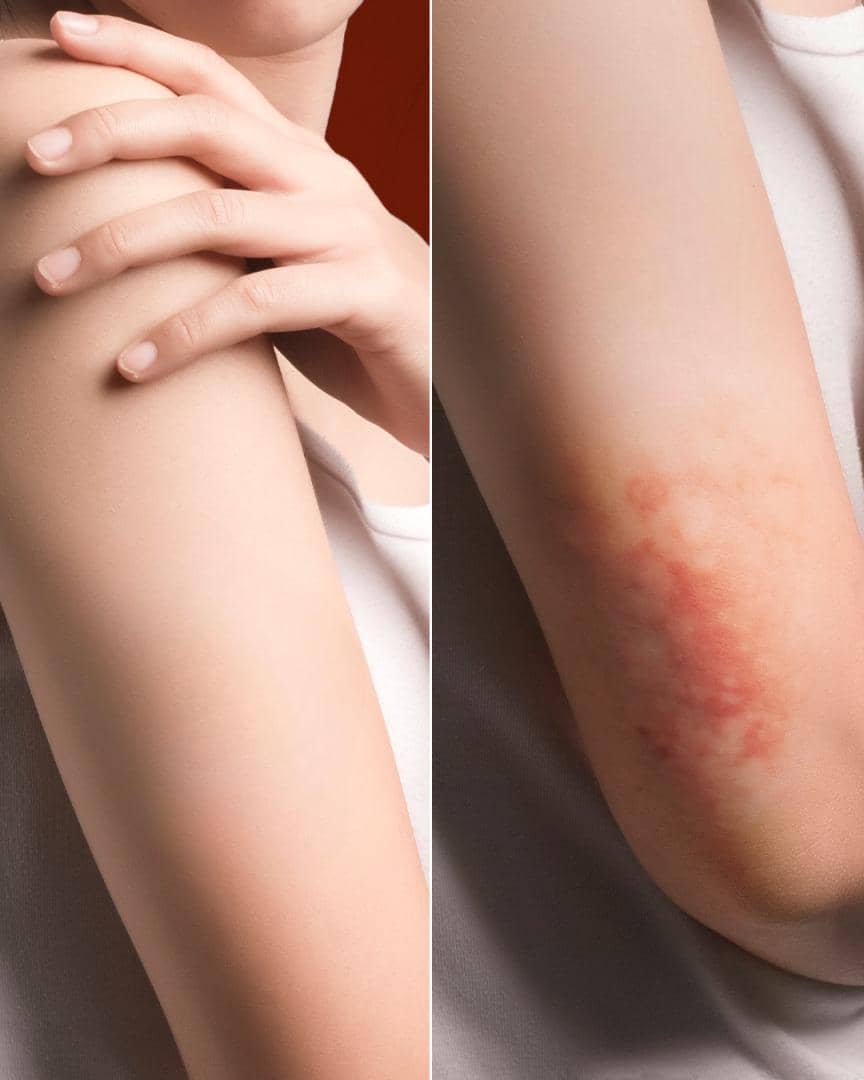 ilustrasi dermatitis atopik