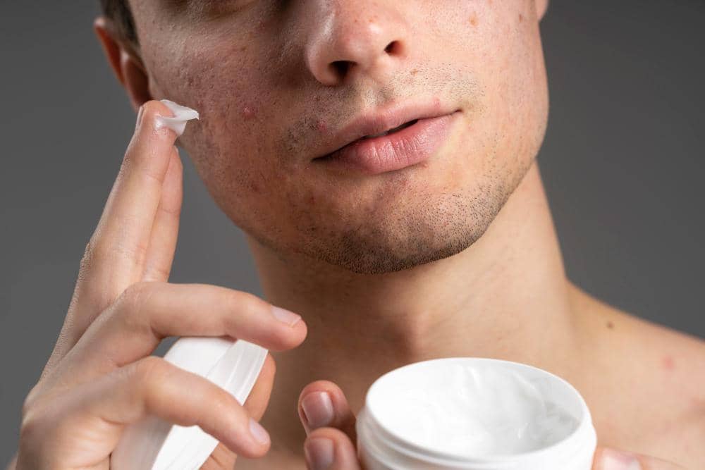 5 Rekomendasi Moisturizer Brand Lokal untuk Mengatasi Kulit Berjerawat