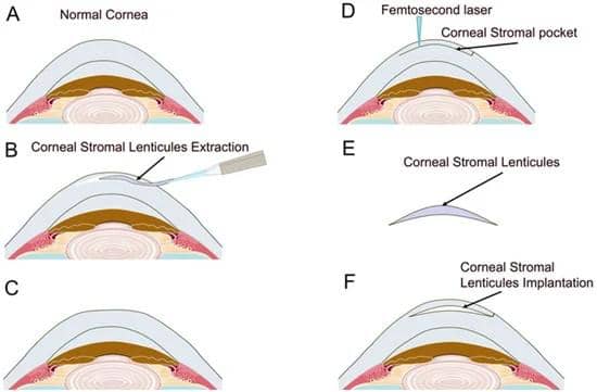 Ilustrasi tahapan prosedur Small Incision Lenticule Extraction (SMILE) pada kornea mata untuk koreksi penglihatan.