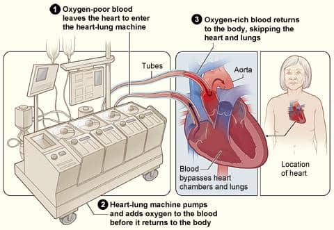 Ilustrasi mesin bypass jantung-paru yang mengalirkan dan mengoksigenasi darah selama prosedur operasi jantung.