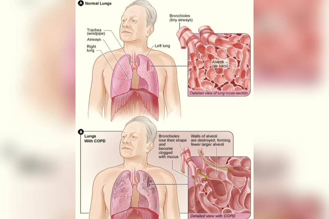 Gambar A menunjukkan paru-paru yang sehat, dan gambar B menunjukkan paru-paru yang rusak akibat PPOK.