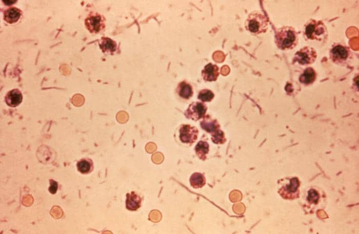 Fotomikrograf eksudat tinja pasien shigelosis, dikenal sebagai disentri Shigella atau disentri bakteri.
