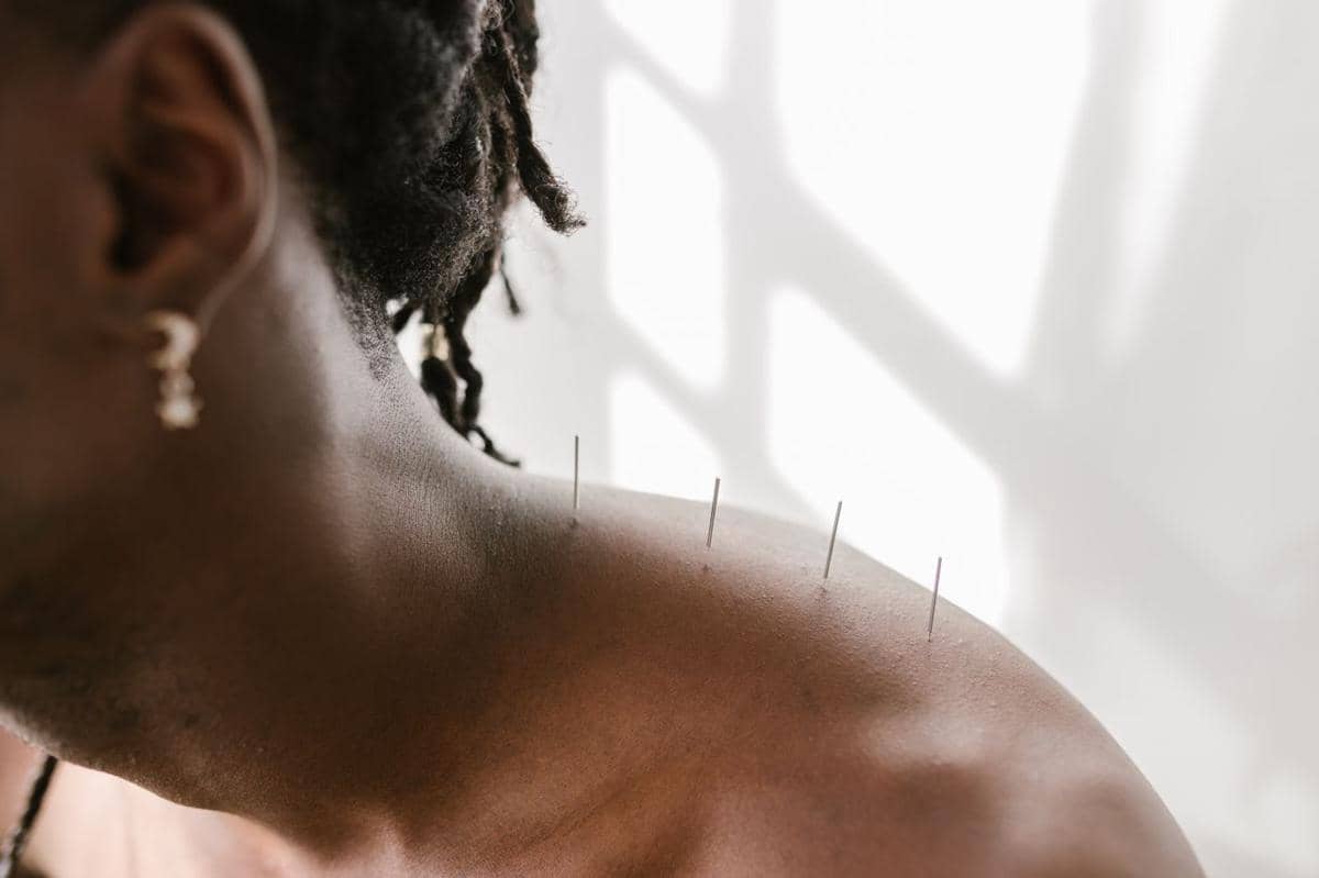 Nyeri Otot Menetap, Kapan Terapi Dry Needling Bisa Dicoba?