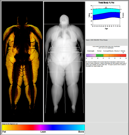 Ilustrasi alat pemeriksaan DEXA atau DXA scan, dengan pasien berbaring di meja pemindaian medis.